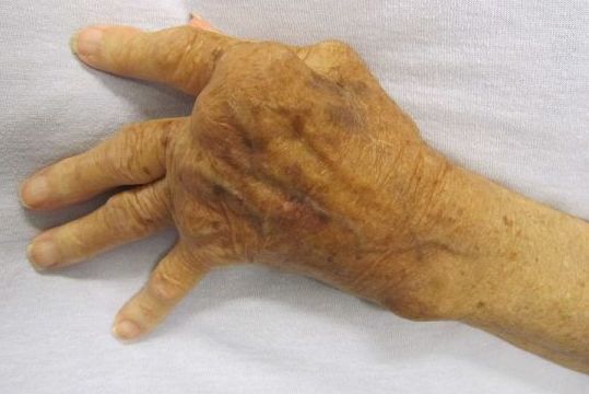 a hand with severe rheumatoid arthritis